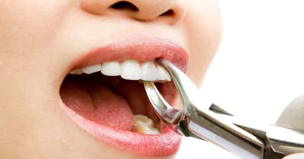 تفسير حلم خلع الأسنان والضروس