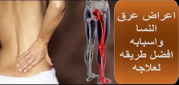 أعراض عرق النسا