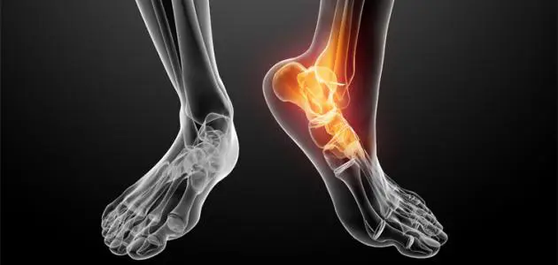 9 أعشاب لتخفيف ألم المفاصل والعظام