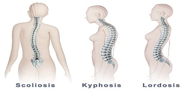 أعراض انحناء العمود الفقري للكبار