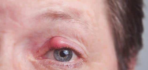 علاج جفن العين الملتهب في المنزل