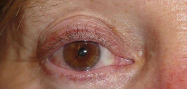 كيفية علاج فطريات جفن العين
