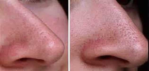 كيفية علاج مسامات الوجه والأنف الواسعة