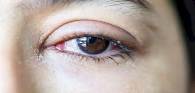 ما هو علاج دموع العين بالأعشاب