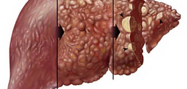 مضاعفات التهاب تليف الكبد