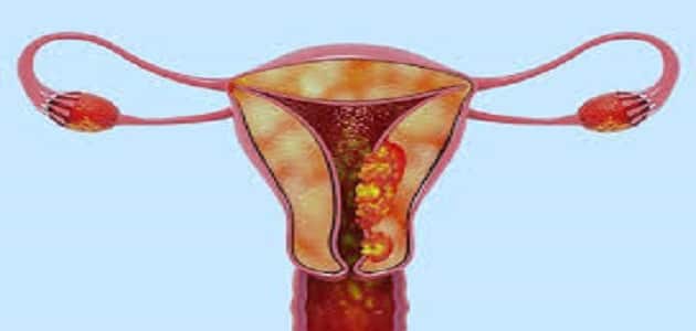 هل نزول لحمية الرحم تسبب سرطان النساء؟