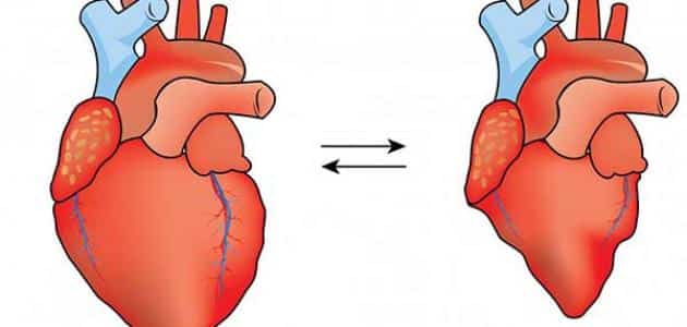 علاج صمام القلب دون جراحة