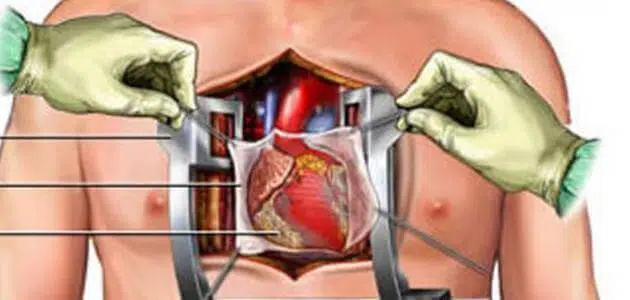 هل عملية القلب المفتوح خطيرة