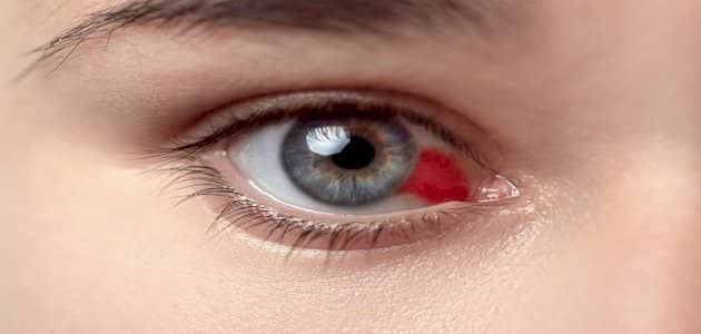 علاج بقعة دم في بياض العين بسبب ضربة