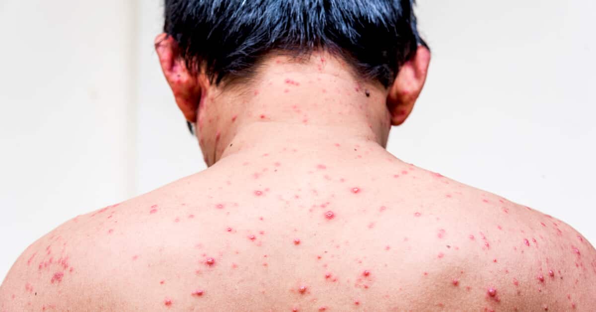 الأعراض الجلدية لمرض الإيدز