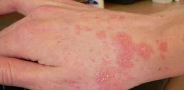 أعراض الأولية لمرض الإيدز