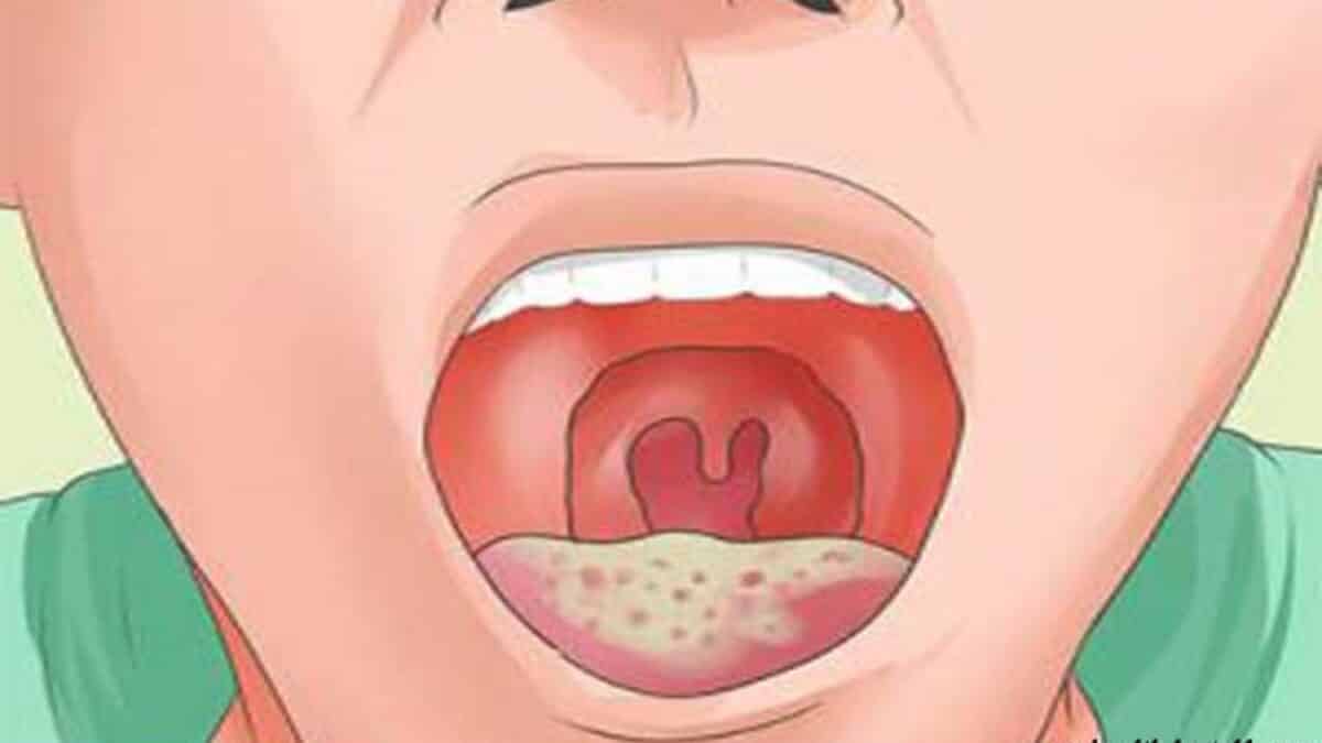 أعراض مرض الإيدز بالصور