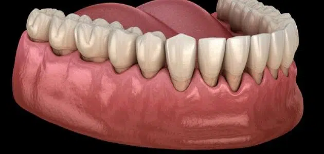 علاج نزول اللثة وتعري الأسنان