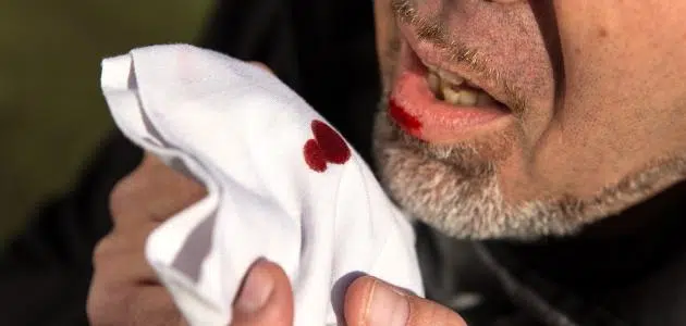 نزول دم من الفم عند الصباح فقط