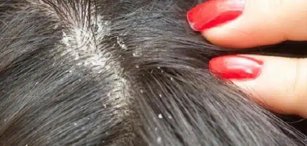 أفضل شامبو للقشرة مجرب